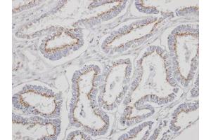 IHC-P Image Immunohistochemical analysis of paraffin-embedded human endometrial cancer, using YIPF4, antibody at 1:500 dilution. (YIPF4 抗体)