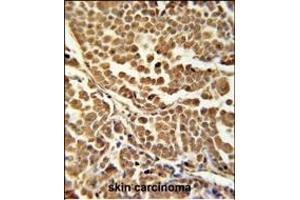 ZN Antibody (C-term) (ABIN651881 and ABIN2840437) immunohistochemistry analysis in formalin fixed and paraffin embedded human skin carcinoma followed by peroxidase conjugation of the secondary antibody and DAB staining. (RNF114 抗体  (C-Term))