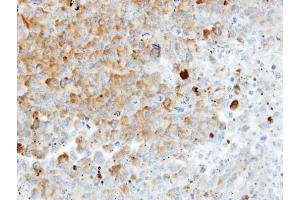 IHC-P Image Immunohistochemical analysis of paraffin-embedded H1299 xenograft, using HIP55, antibody at 1:100 dilution. (DBNL 抗体  (N-Term))