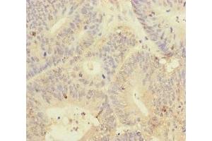 Immunohistochemistry of paraffin-embedded human colon cancer using ABIN7145011 at dilution of 1:100 (YME1L1 抗体  (AA 1-240))