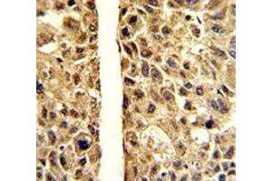 IHC analysis of FFPE human hepatocarcinoma stained with ARG1 antibody (Liver Arginase 抗体  (AA 293-322))
