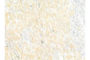 ABIN6264572 and ABIN6279737 at 1/100 staining human hepatocellular carcinoma by IHC-P. (RAB33B 抗体  (Internal Region))