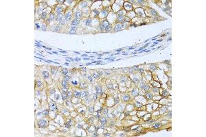 Immunohistochemistry of paraffin-embedded human prostate cancer using BMP4 antibody at dilution of 1:100 (40x lens). (BMP4 抗体)