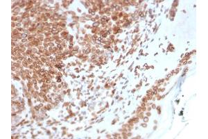 Formalin-fixed, paraffin-embedded human Basal Cell Carcinoma stained with Emerin Mouse Monoclonal Antibody (EMD/2168). (Emerin 抗体  (AA 56-167))