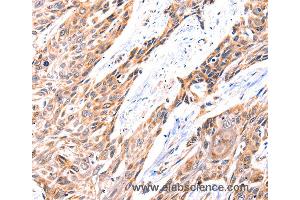 Immunohistochemistry of Human esophagus cancer using GNRHR Polyclonal Antibody at dilution of 1:117