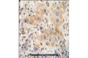 NR0B2 antibody immunohistochemistry analysis in formalin fixed and paraffin embedded human hepatocarcinoma followed by peroxidase conjugation of the secondary antibody and DAB staining. (NR0B2 抗体  (AA 56-83))