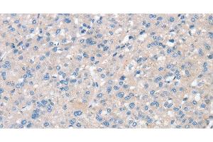 Immunohistochemistry of paraffin-embedded Human liver cancer using SNX3 Polyclonal Antibody at dilution of 1:30 (Sorting Nexin 3 抗体)