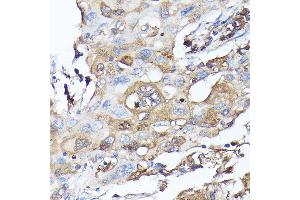 Immunohistochemistry of paraffin-embedded human lung cancer using MLST8 Rabbit pAb (ABIN6131371, ABIN6143894, ABIN6143895 and ABIN6217660) at dilution of 1:100 (40x lens). (GBL 抗体  (AA 1-326))