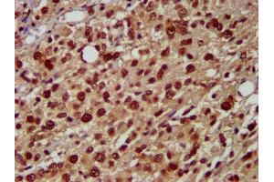 IHC image of ABIN7155093 diluted at 1:500 and staining in paraffin-embedded human glioma performed on a Leica BondTM system. (HNRNPAB 抗体  (AA 1-68))