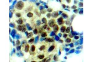 Immunohistochemistry of paraffin-embedded Human breast carcinoma tissue, using Phospho-MAPK3(T202) Polyclonal Antibody (ERK1 抗体  (pThr202))