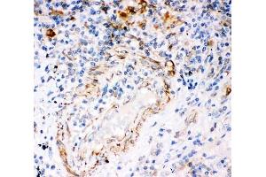 IHC-P: IP3R antibody testing of human lung cancer tissue (ITPR3 抗体  (AA 2411-2758))