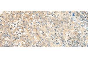 Immunohistochemistry of paraffin-embedded Human cervical cancer tissue using C5AR2 Polyclonal Antibody at dilution of 1:25(x200) (GPR77 抗体)