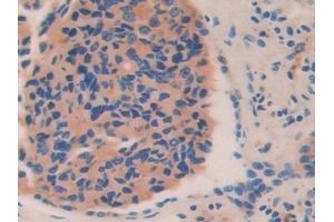 Detection of HEXb in Human Prostate cancer Tissue using Polyclonal Antibody to Hexosaminidase B Beta (HEXb) (HEXB 抗体  (AA 122-311))