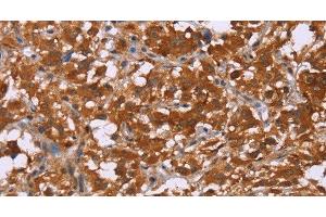 Immunohistochemistry of paraffin-embedded Human thyroid cancer tissue using DCBLD2 Polyclonal Antibody at dilution 1:50 (DCBLD2 抗体)