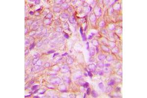 Immunohistochemical analysis of PKC delta (pY313) staining in human breast cancer formalin fixed paraffin embedded tissue section. (PKC delta 抗体  (pTyr313))
