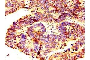 IHC image of ABIN7168252 diluted at 1:300 and staining in paraffin-embedded human ovarian cancer performed on a Leica BondTM system. (RNF219 抗体  (AA 257-465))