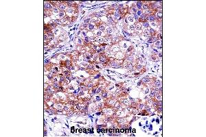 IDH1 Antibody (C-term) ((ABIN657472 and ABIN2846500))immunohistochemistry analysis in formalin fixed and paraffin embedded human breast carcinoma followed by peroxidase conjugation of the secondary antibody and DAB staining. (IMPDH1 抗体  (C-Term))