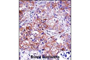 IDH1 Antibody (C-term) ((ABIN657472 and ABIN2846500))immunohistochemistry analysis in formalin fixed and paraffin embedded human breast carcinoma followed by peroxidase conjugation of the secondary antibody and DAB staining.