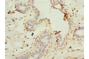 Immunohistochemistry of paraffin-embedded human breast cancer using ABIN7147425 at dilution of 1:100 (Cep76 抗体  (AA 241-550))