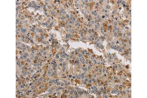 Immunohistochemistry of Human liver cancer using KIF17 Polyclonal Antibody at dilution of 1:40 (KIF17 抗体)