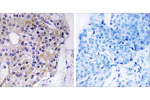 Peptide - +Immunohistochemistry analysis of paraffin-embedded human breast carcinoma tissue using CEP110 antibody. (Centriolin 抗体)