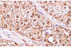 Immunohistochemistry of paraffin-embedded Human liver cancer using CDK4 Polyclonal Antibody at dilution of 1:100 (CDK4 抗体)