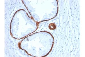 Formalin-fixed, paraffin-embedded human Prostate Carcinoma stained with Cytokeratin 14 Mouse Monoclonal Antibody (KRT14/2375). (KRT14 抗体  (AA 351-472))