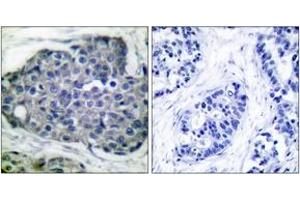 Immunohistochemistry analysis of paraffin-embedded human breast carcinoma, using Acetyl-CoA Carboxylase (Phospho-Ser80) Antibody. (Acetyl-CoA Carboxylase 抗体  (pSer80))