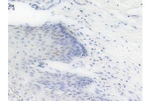 Phospho-PHB2 (Ser39) Antibody at 1/100 staining human cervical carcinoma by IHC-P. (Prohibitin 2 抗体  (pSer39))
