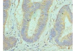 Immunohistochemistry of paraffin-embedded human colon cancer using ABIN7154290 at dilution of 1:100 (GOLM1 抗体  (AA 112-401))