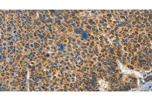 Immunohistochemistry of paraffin-embedded Human liver cancer tissue using IFT74 Polyclonal Antibody at dilution 1:60 (IFT74 抗体)