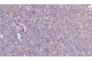 ABIN6273059 at 1/100 staining Human lymph cancer tissue by IHC-P. (NAPRT1 抗体  (Internal Region))