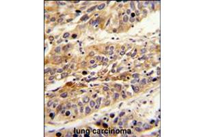 Formalin-fixed and paraffin-embedded human lung carcinoma reacted with LRG1 Antibody , which was peroxidase-conjugated to the secondary antibody, followed by DAB staining.