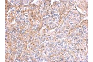 IHC-P Image PPFIBP2 antibody detects PPFIBP2 protein at on SkHep1 xenograft by immunohistochemical analysis. (PPFIBP2 抗体  (Center))