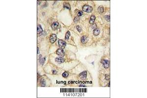 Formalin-fixed and paraffin-embedded human lung carcinoma tissue reacted with CD14 antibody (C-term), which was peroxidase-conjugated to the secondary antibody, followed by DAB staining. (CD14 抗体  (C-Term))