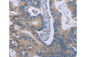 Immunohistochemistry of Human colon cancer using HYAL3 Polyclonal Antibody at dilution of 1:40 (HYAL3 抗体)