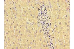 Immunohistochemistry of paraffin-embedded human liver cancer using ABIN7155713 at dilution of 1:100 (HOXA2 抗体  (AA 26-124))