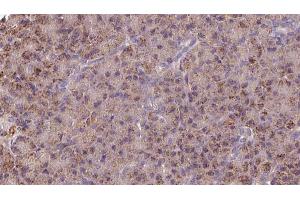 ABIN6273252 at 1/100 staining Human pancreas cancer tissue by IHC-P. (GSTM3 抗体  (C-Term))