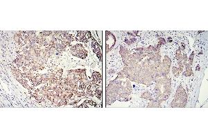 Immunohistochemical analysis of paraffin-embedded galactophore tumour using ERBB2 mouse mAb with DAB staining (ErbB2/Her2 抗体  (AA 750-987))