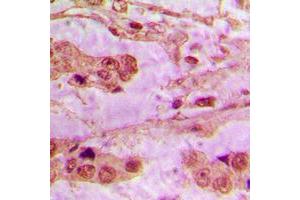 Immunohistochemical analysis of API5 staining in human lung cancer formalin fixed paraffin embedded tissue section. (Apoptosis Inhibitor 5 抗体  (C-Term))