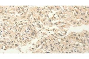 Immunohistochemistry of paraffin-embedded Human esophagus cancer tissue using FZD8 Polyclonal Antibody at dilution 1:50 (FZD8 抗体)