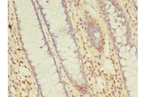 Immunohistochemistry of paraffin-embedded human colon cancer using ABIN7164329 at dilution of 1:100 (NARS2 抗体  (AA 15-210))