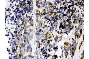 Anti- Cyclin A2 Picoband antibody, IHC(P) IHC(P): Human Lung Cancer Tissue (Cyclin A 抗体  (AA 10-168))