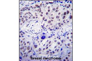 USF1 Antibody (Center) (ABIN655030 and ABIN2844661) immunohistochemistry analysis in formalin fixed and paraffin embedded human breast carcinoma followed by peroxidase conjugation of the secondary antibody and DAB staining. (USF1 抗体  (AA 174-201))