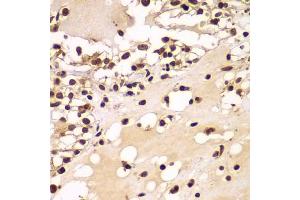 Immunohistochemistry of paraffin-embedded human kidney cancer using ZNF20 antibody  at dilution of 1:100 (40x lens). (ZNF20 抗体  (AA 1-200))