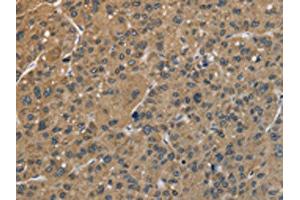 The image is immunohistochemistry of paraffin-embedded Human liver cancer tissue using ABIN7128907(CENPN Antibody) at dilution 1/70. (CENPN 抗体)