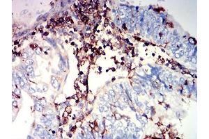 Immunohistochemical analysis of paraffin-embedded endometrial cancer tissues using CD97 mouse mAb with DAB staining. (CD97 抗体  (AA 419-552))