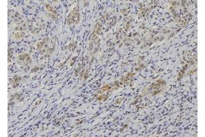 ABIN6274254 at 1/100 staining Human lung cancer tissue by IHC-P. (NBL1 抗体  (C-Term))