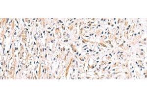 Immunohistochemistry of paraffin-embedded Human prost ate cancer tissue using HLA-DOB Polyclonal Antibody at dilution of 1:40(x200) (HLA-DOB 抗体)