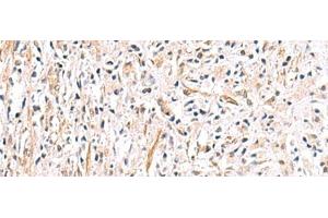Immunohistochemistry of paraffin-embedded Human prost ate cancer tissue using HLA-DOB Polyclonal Antibody at dilution of 1:40(x200) (HLA-DOB 抗体)
